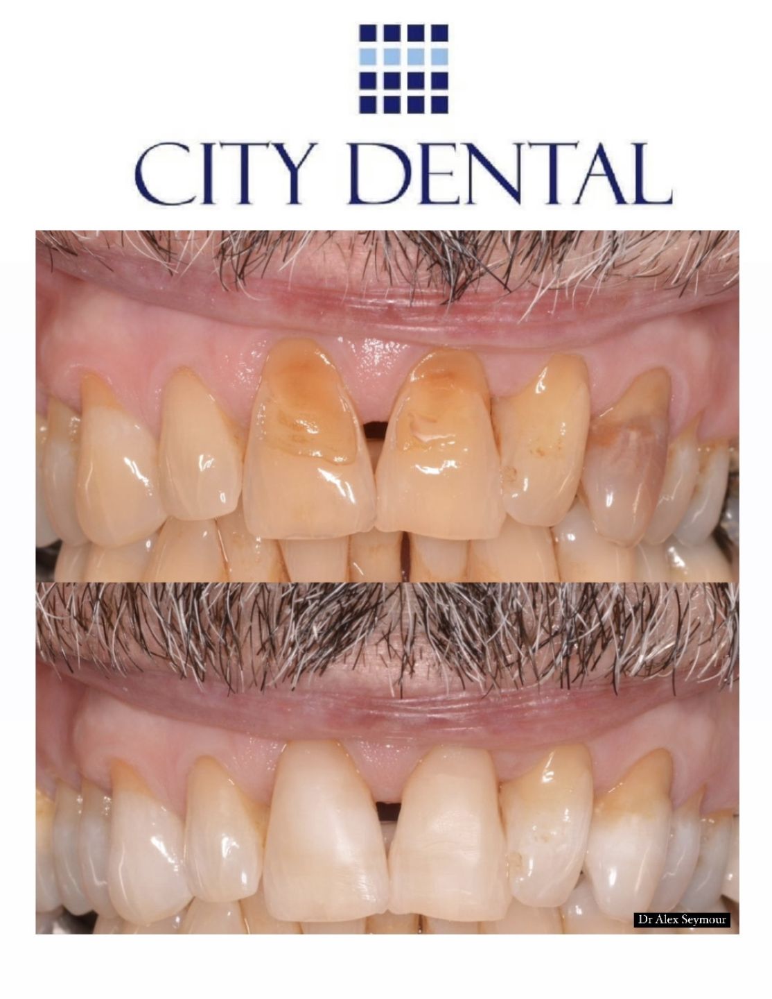 Before and after internal whitening