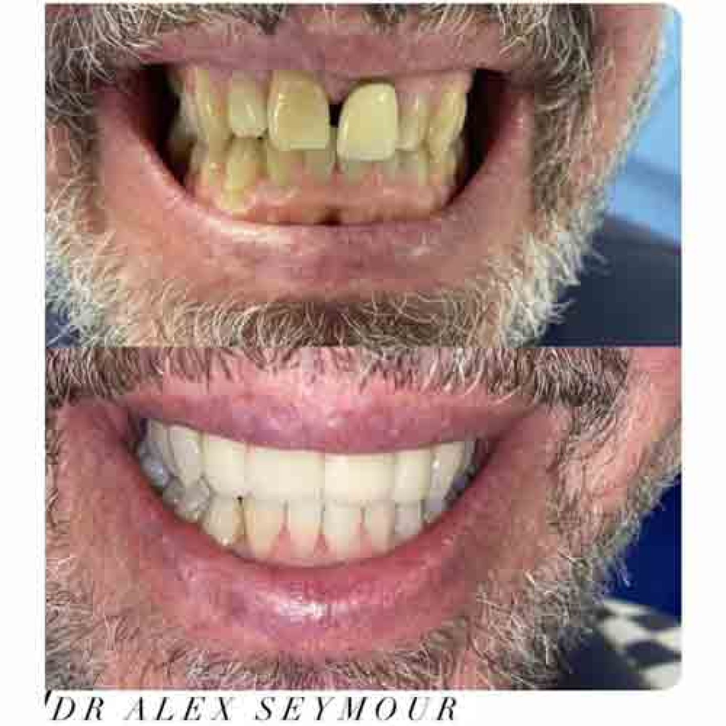 Crowns and whitening
