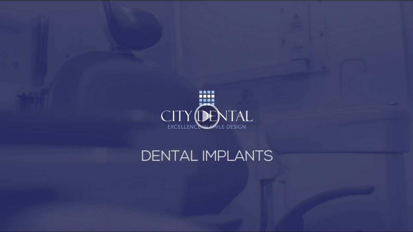 Dental Implants