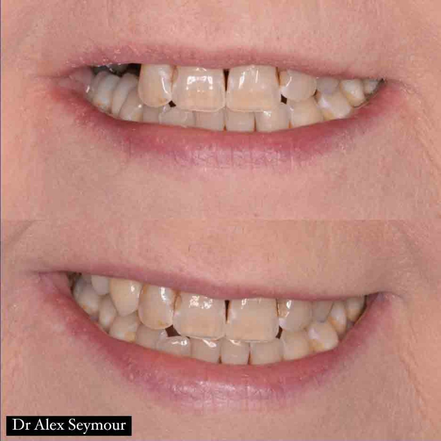implant bridge
