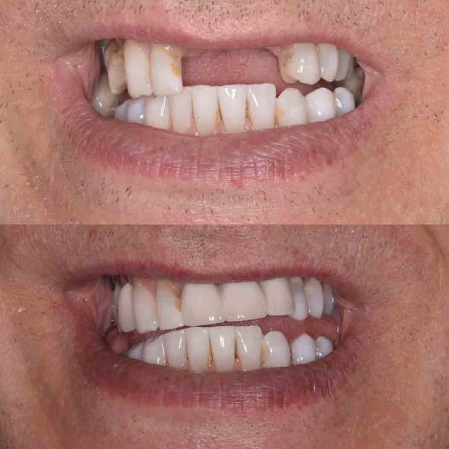 implant bridge2
