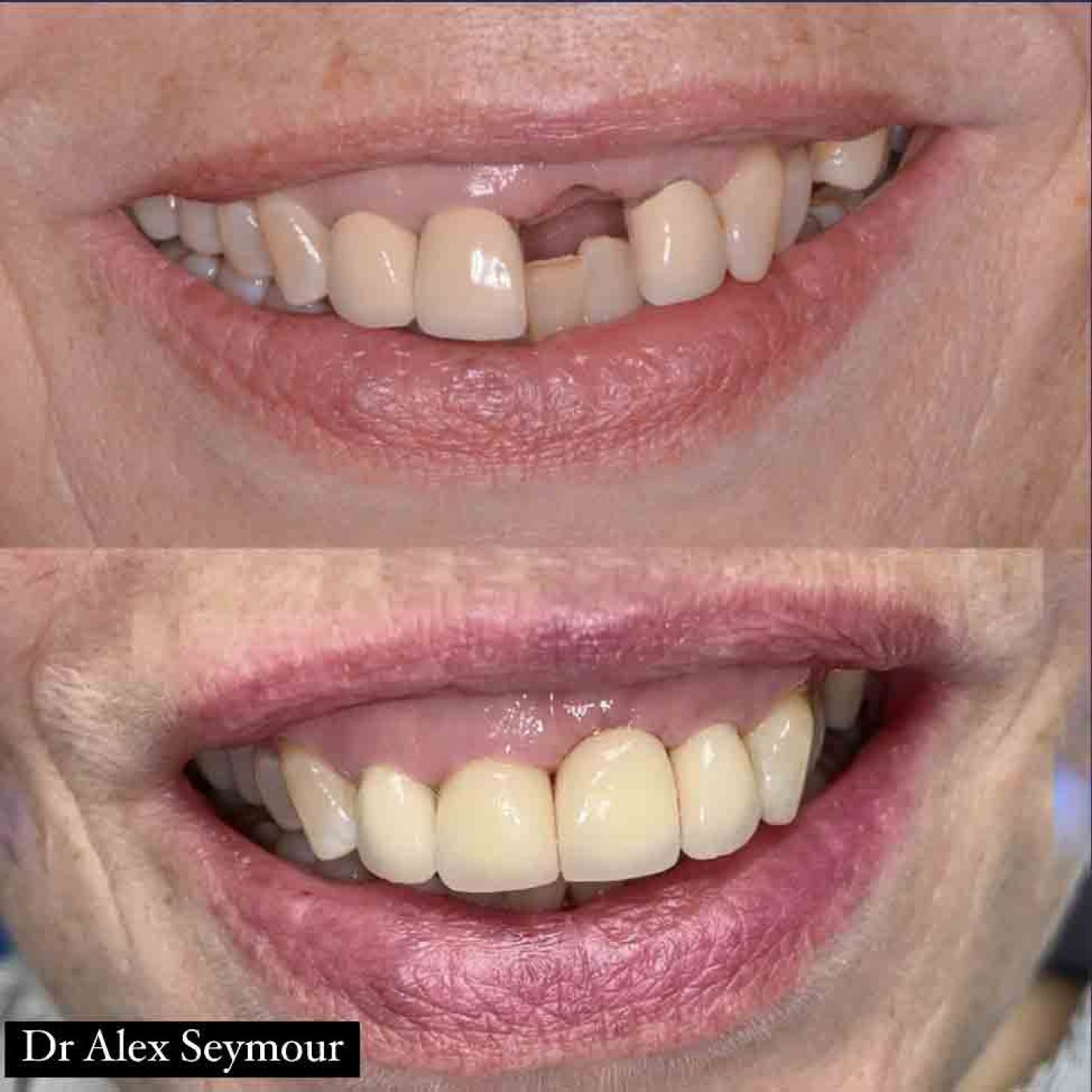 Implant Crown