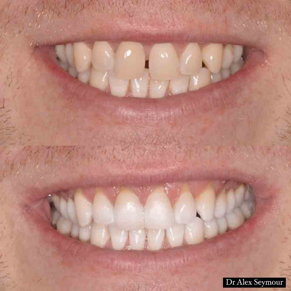 Invisalign 24.11.23