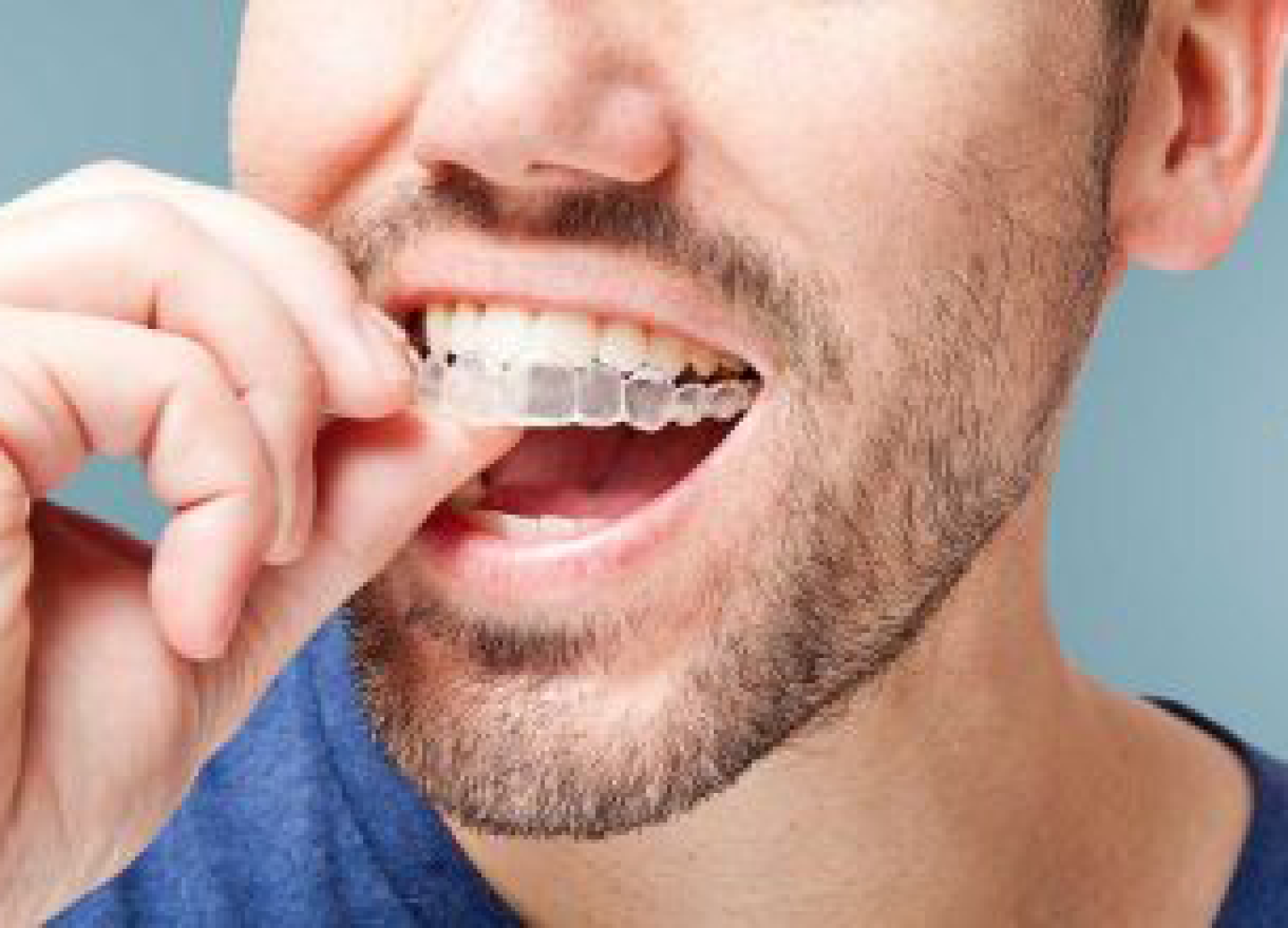 Invisalign Man