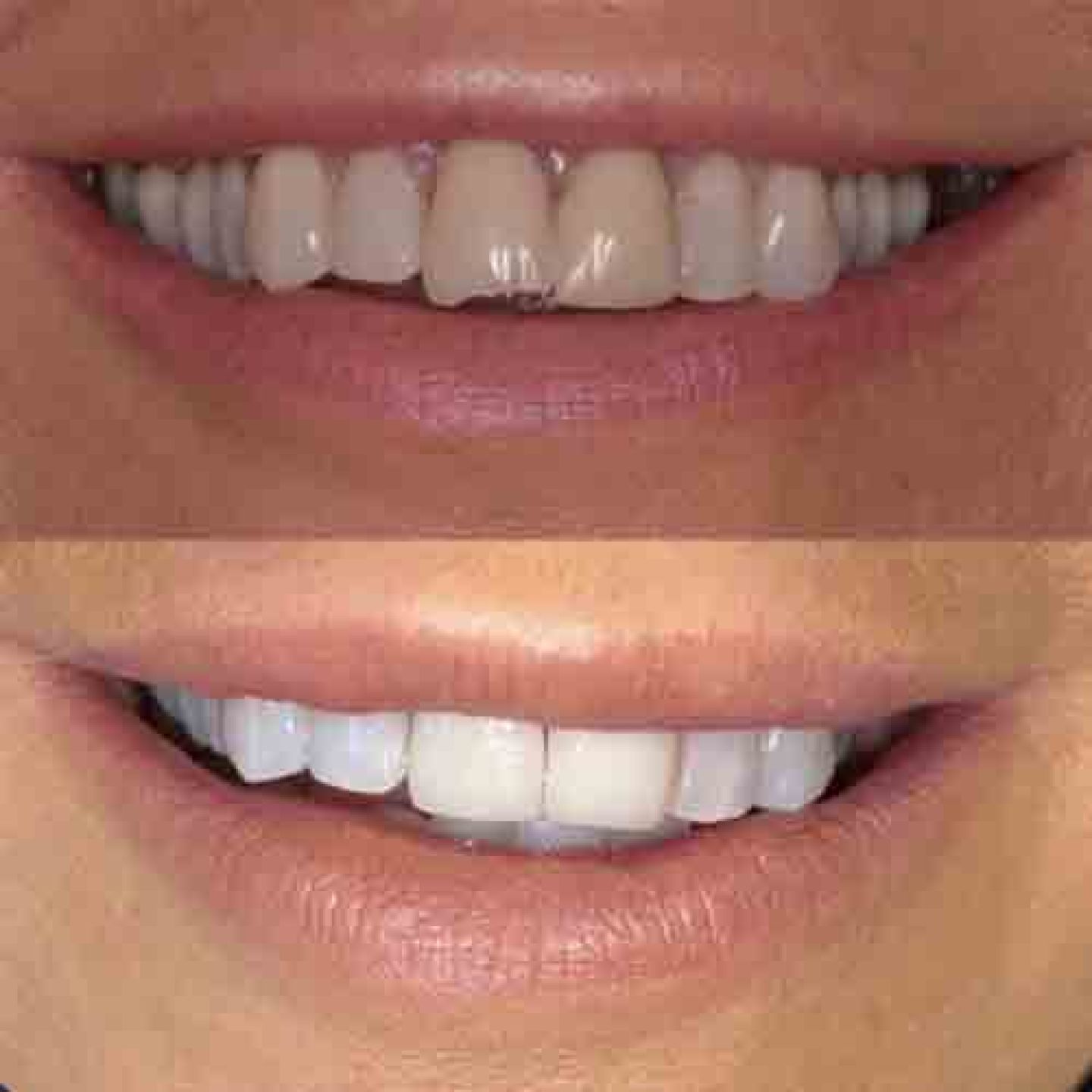 Porcelain veneers
