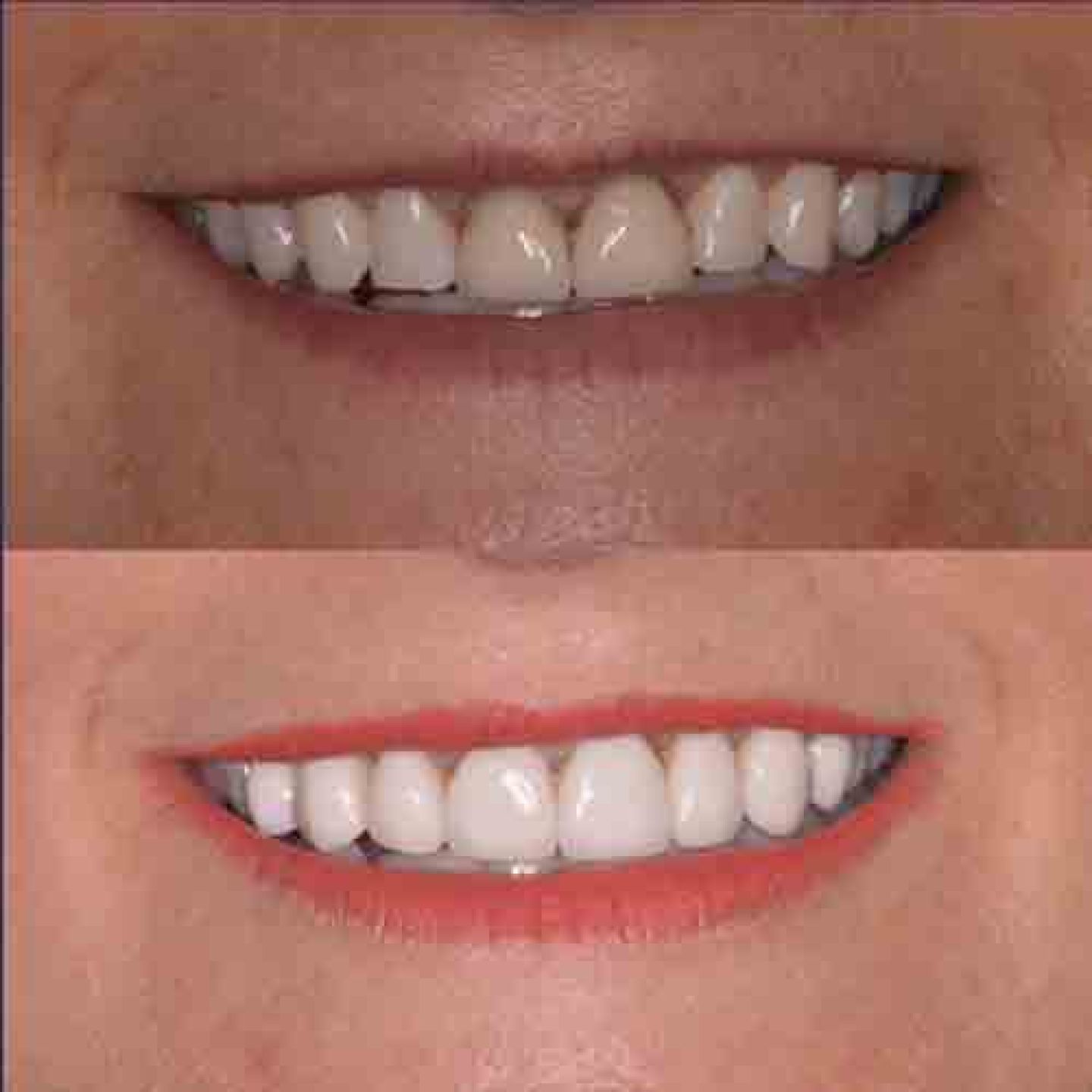 Porcelain veneers