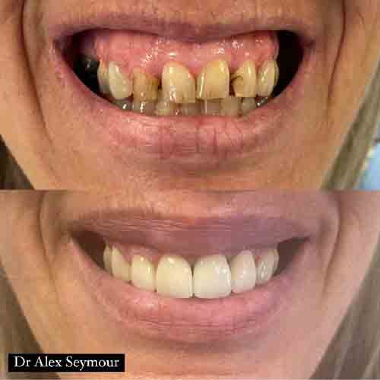 Porcelain veneers1