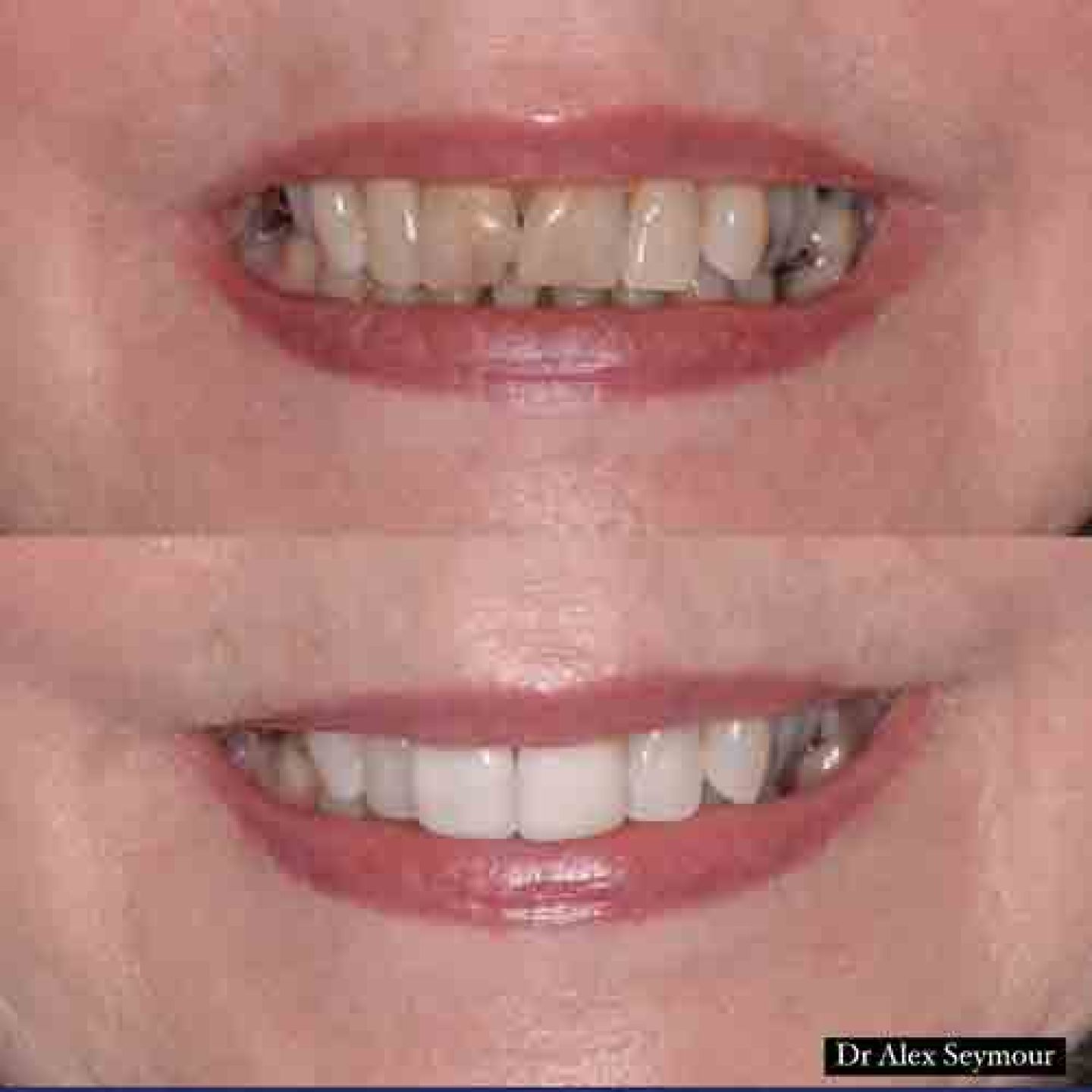 Porcelain veneers2