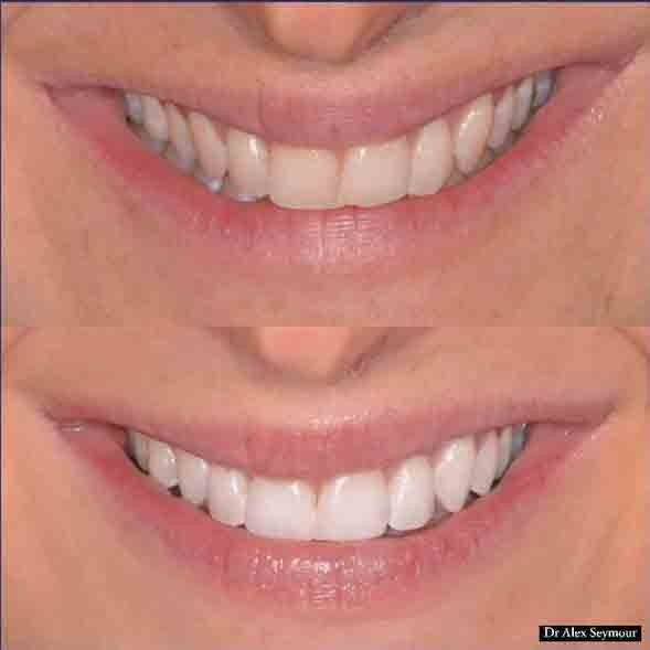Teeth Straigtening