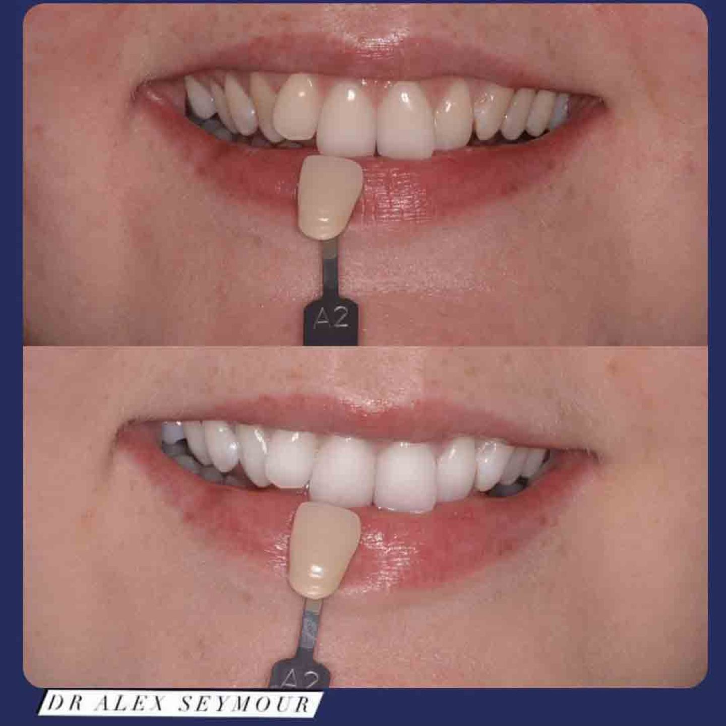 Whitening