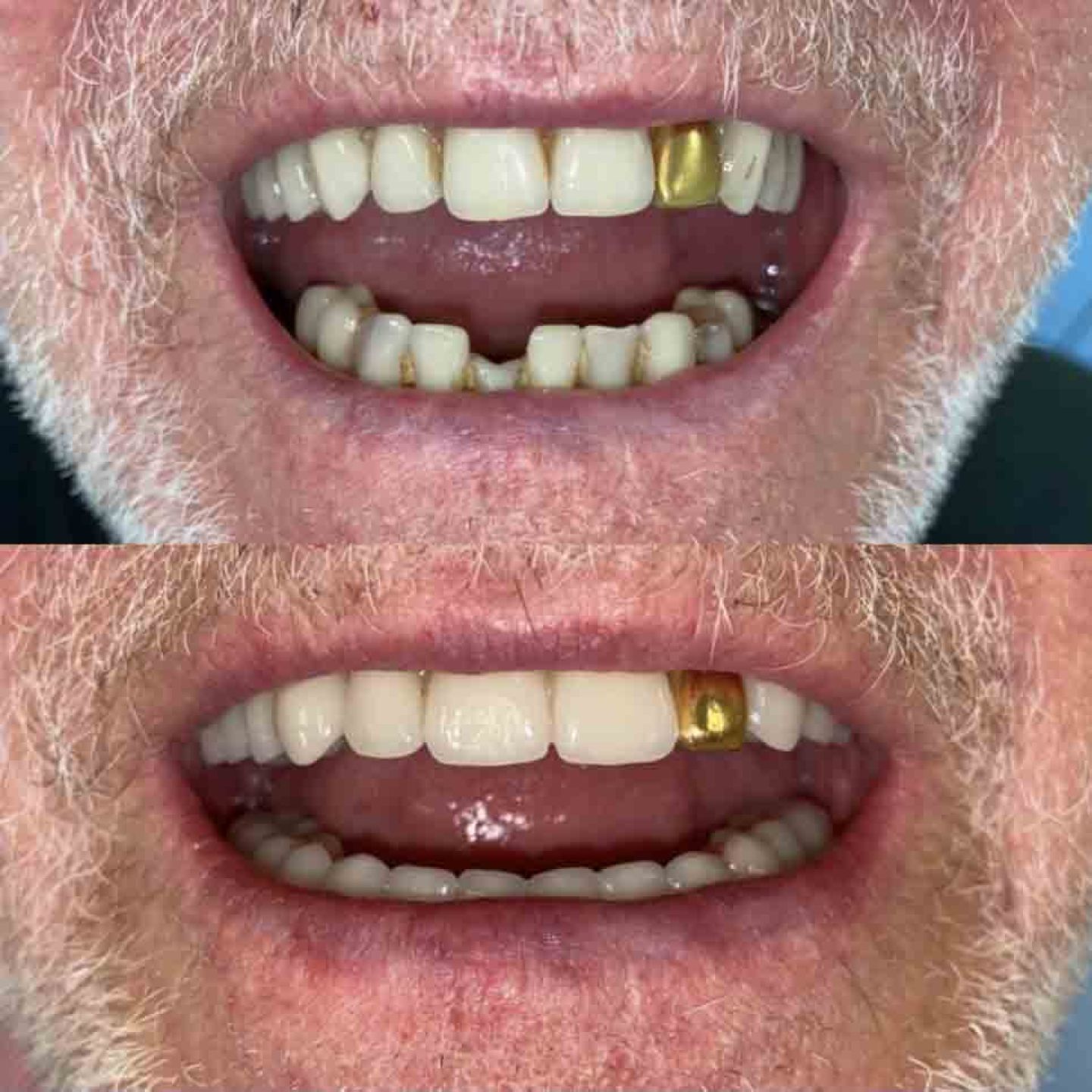 Implants