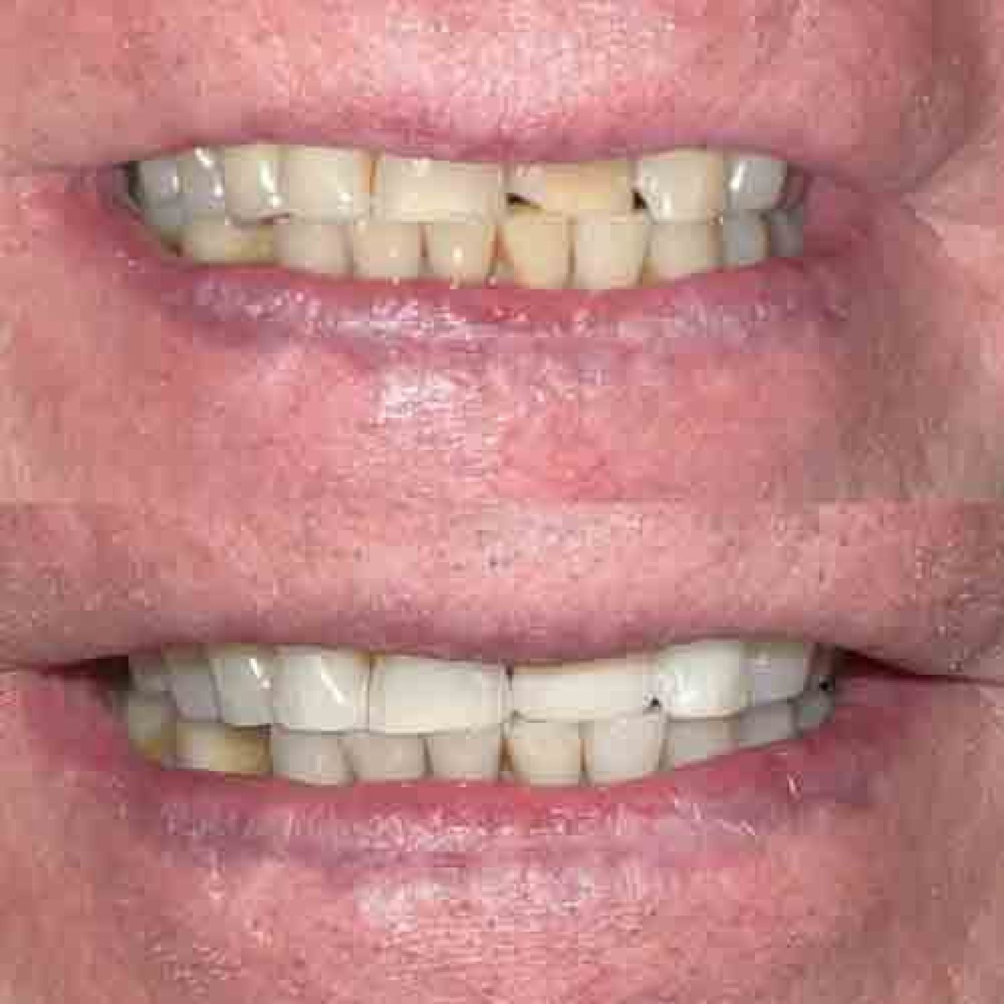 composite bonding and whitening