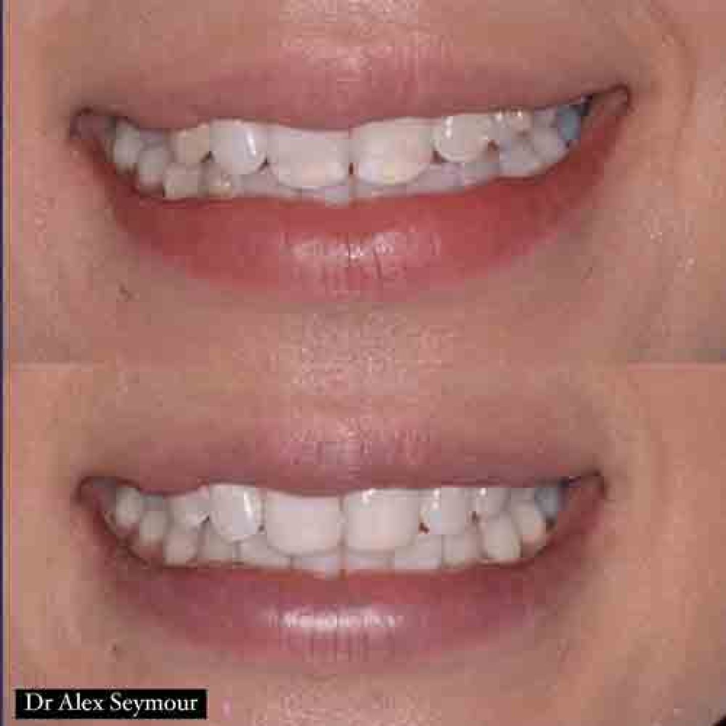 composite bonding 
