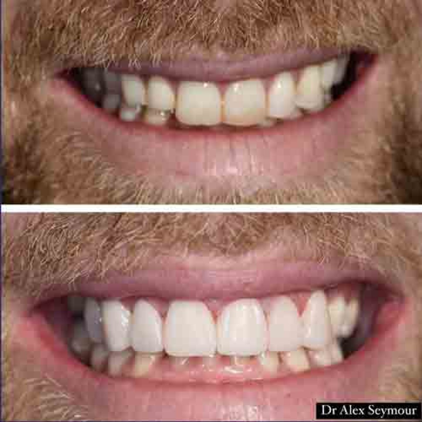 composite bonding 