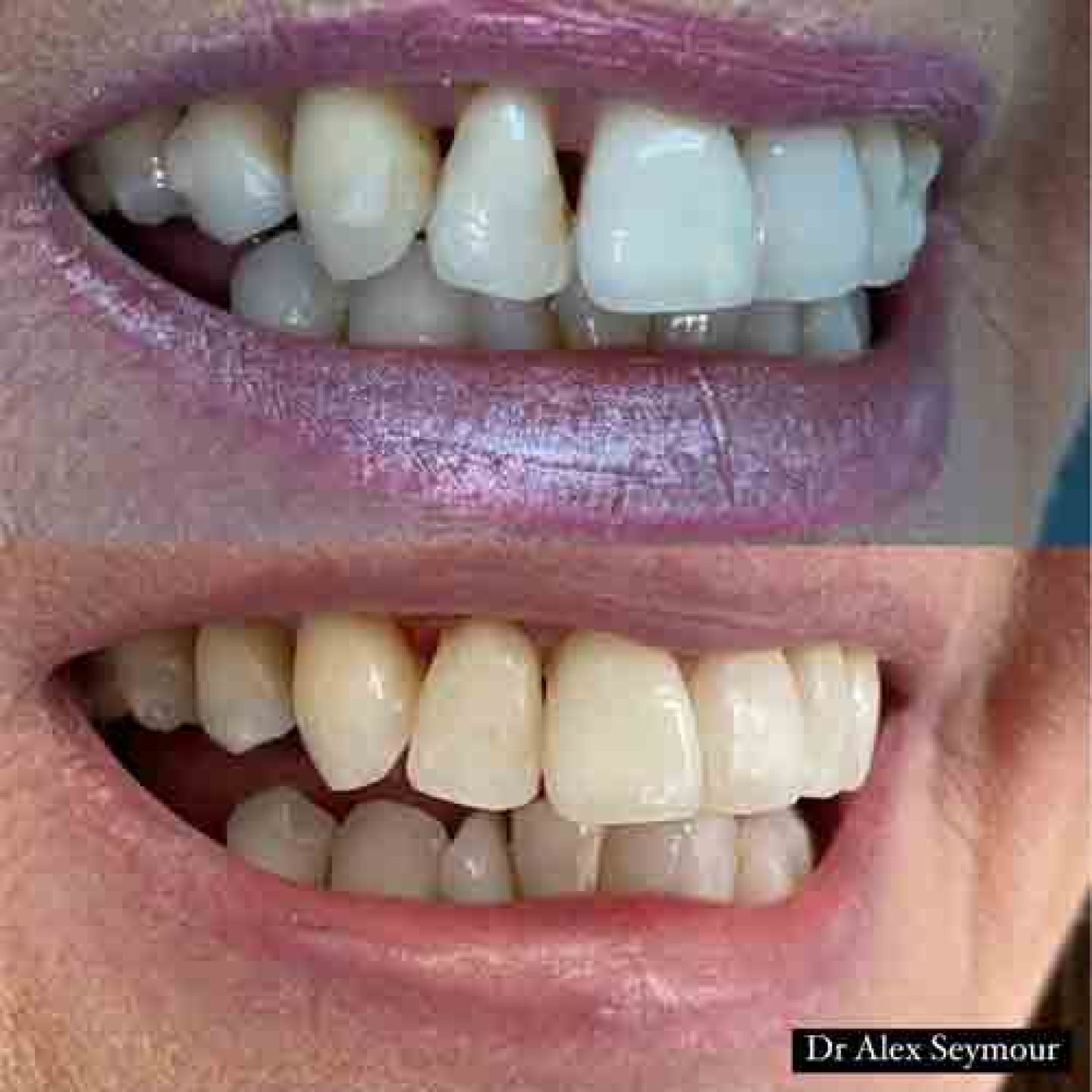 composite bonding 