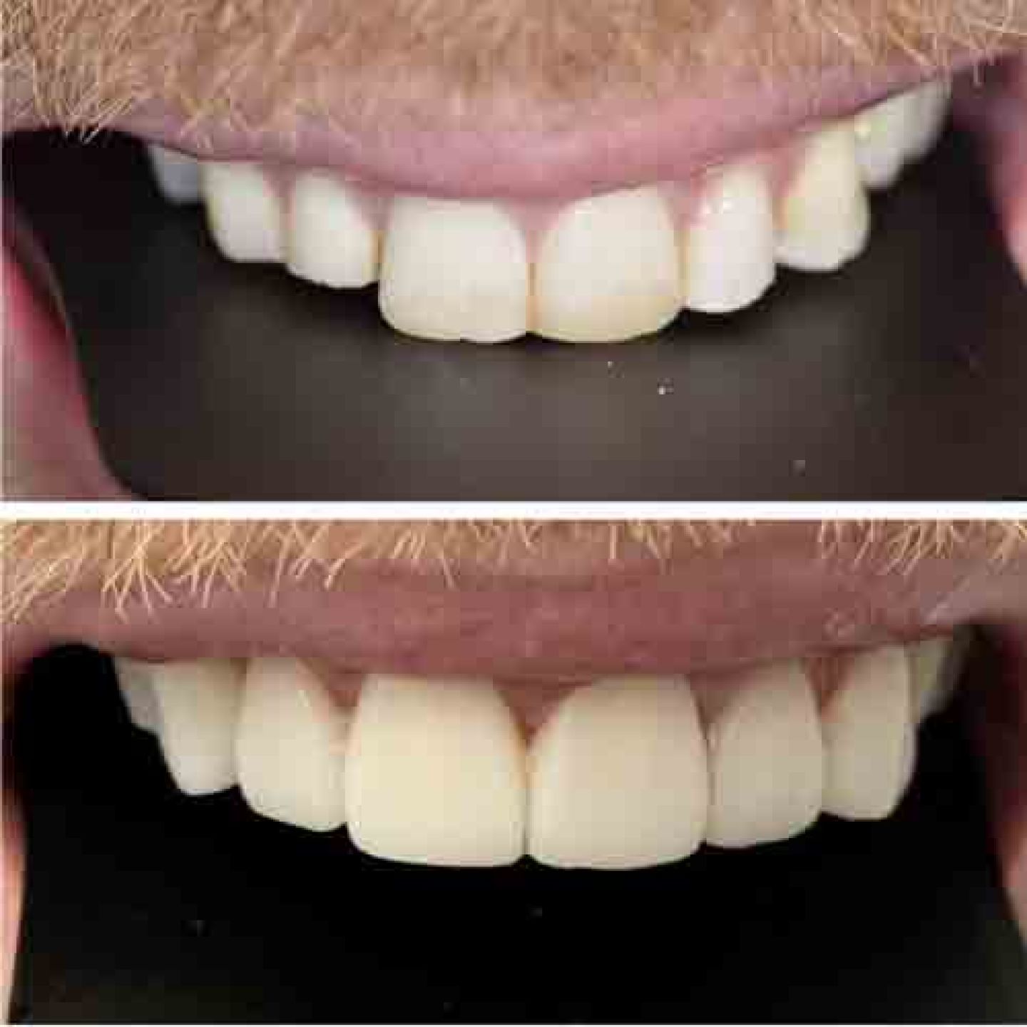 composite bonding 
