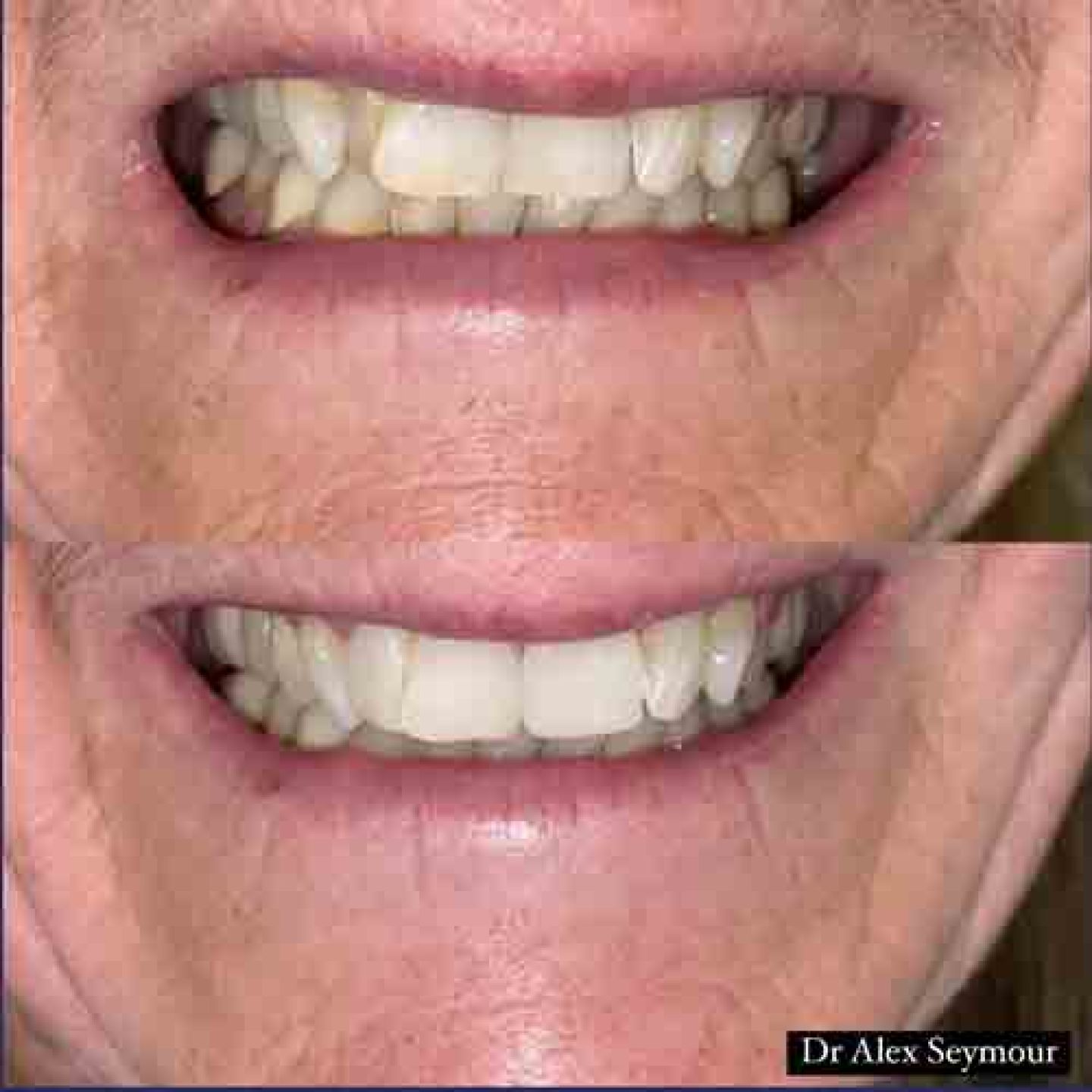 composite bonding 