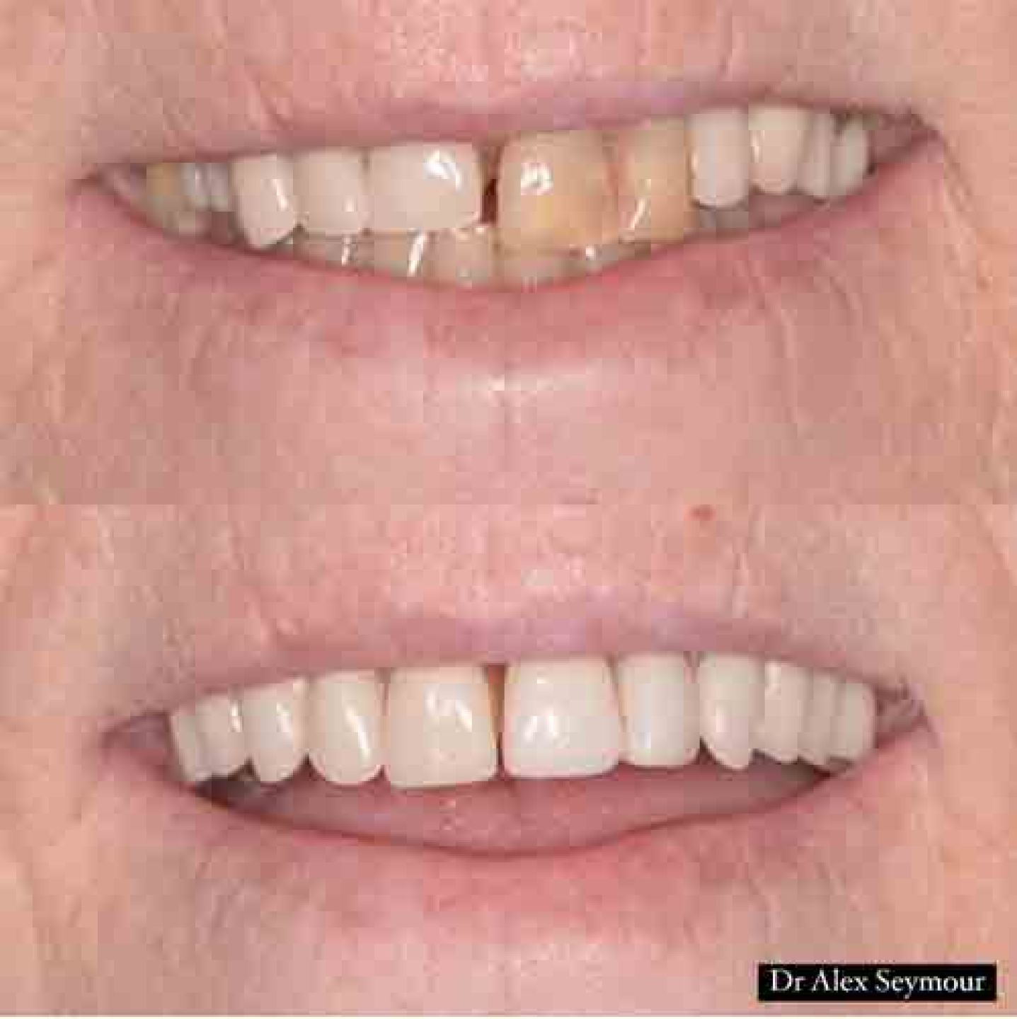 composite veneers and new denture