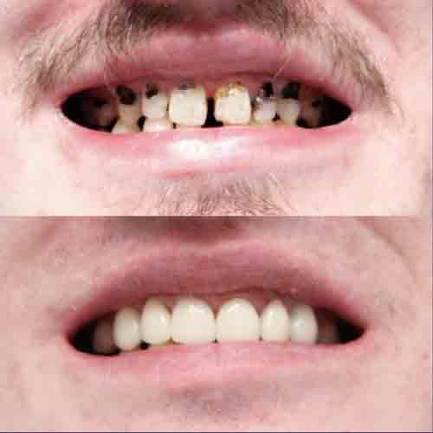 composite veneers1