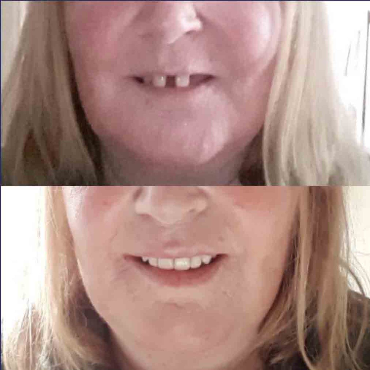 implant retained dentures