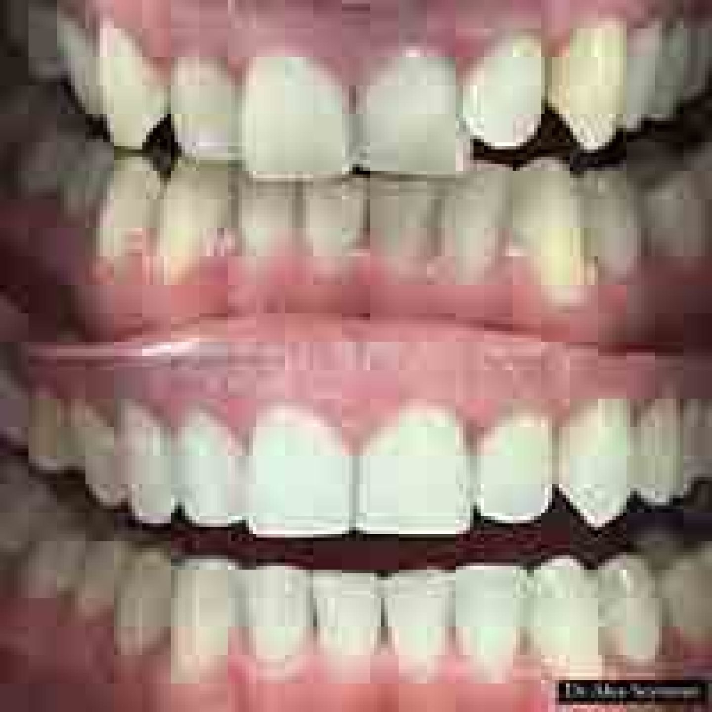 invisalign and whitening